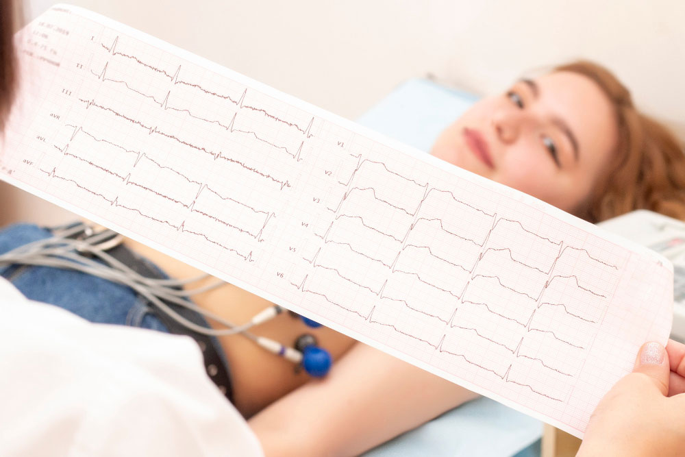 fibrillazione atrilale ecg